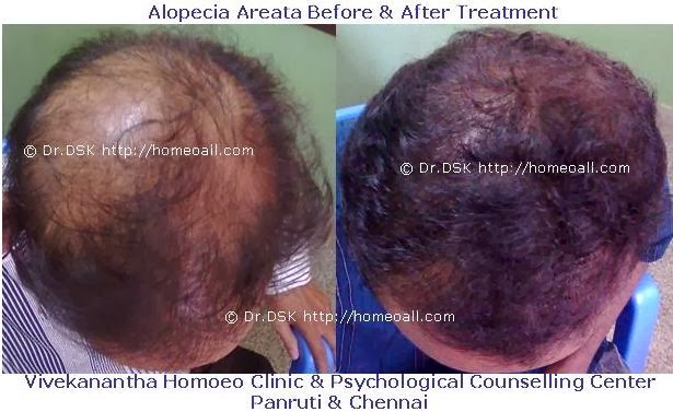 Vivekanantha Homeo Clinic & Psychological Counseling Centre, Chennai: How  to Overcome from Hair Loss / Hair Falling / Male Pattern Baldness (MPB) /  Female Pattern Baldness (FPB) / Baldness -