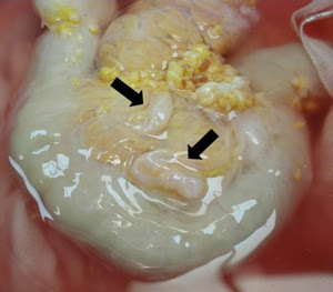 Pancreas Cancer Symptoms