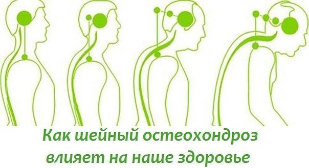 БОЛИТ ШЕЯ КАК ШЕЙНЫЙ ОСТЕОХОНДРОЗ ВЛИЯЕТ НА НАШЕ СОСТОЯНИЕ