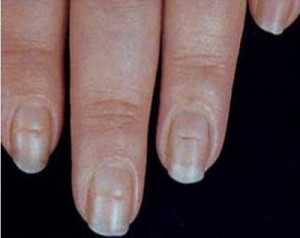 Horizontal lines and brittle nails may indicate that you need a thyroid