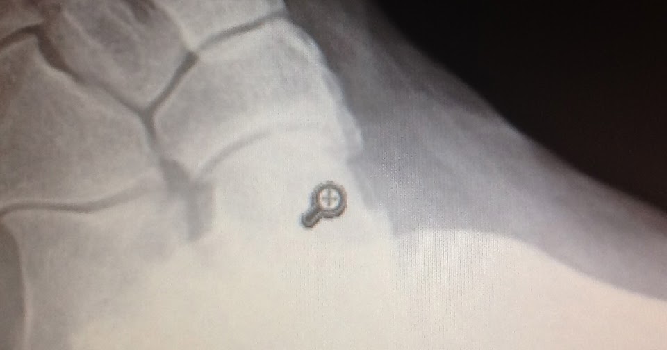 Foot and Ankle Problems By Dr. Richard Blake Navicular Pain Accessory