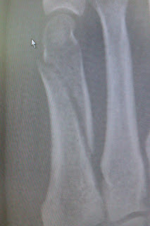 Metatarsal fractures Healing of a broken 5th metatarsal