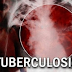 Waspada……!  Tuberkulosis Bisa Serang Otak Anda