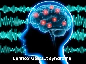 lennox gastaut syndrome expectancy children attacks