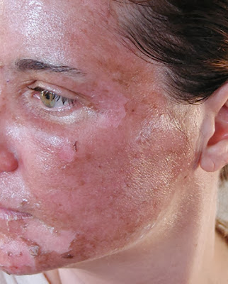 peeling descamação dias