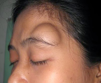 Penyebab Munculnya Penyakit Tumor Jinak | Penyakit Tumor Jinak