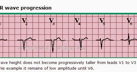 What is the meaning a poor R-wave progression in a cardiogram?