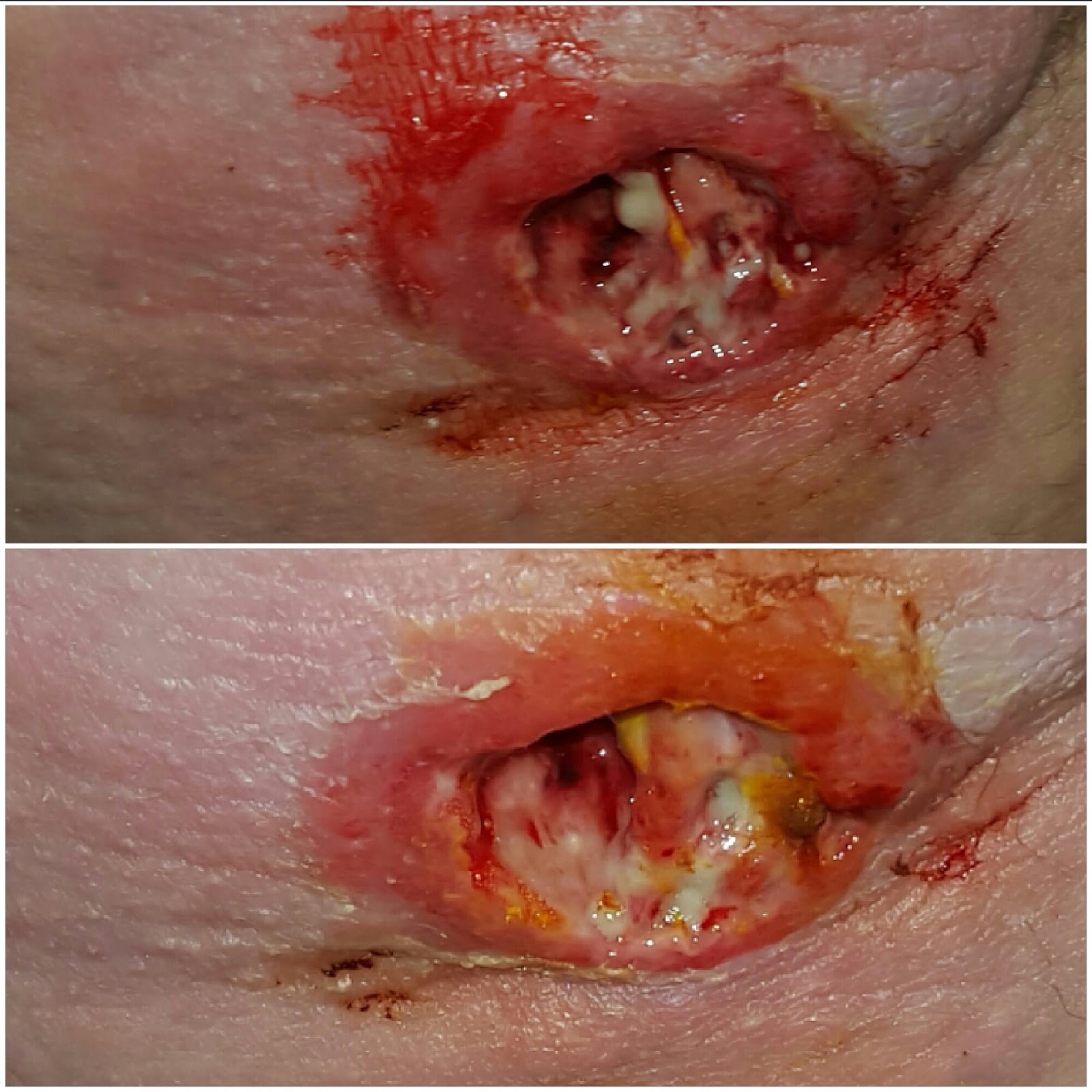How To Treat Mrsa Naturally How To Treat Mrsa Naturally