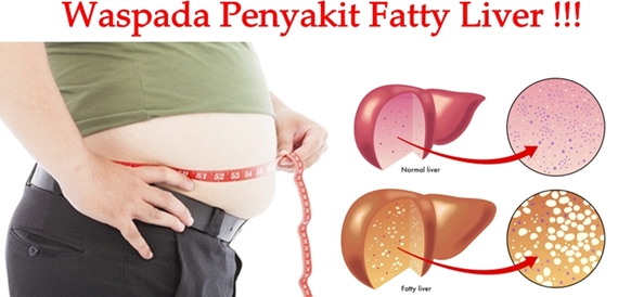 Pengobatan Tradisional Fatty Liver
