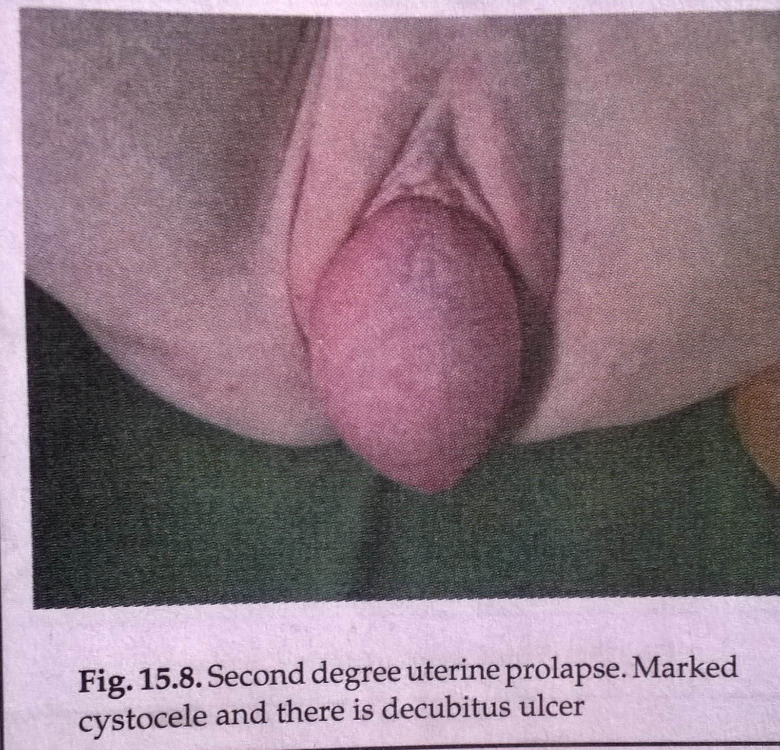 uterin prolaps gratis pornosider uterin prolaps gratis pornosider