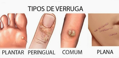 URGO VERRUGAS esta indicado para el tratamiento de las verrugas comunes de pies y manos en adultos y niños a partir de 4 años
