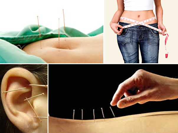 Acupuncture For Weight Loss Nm