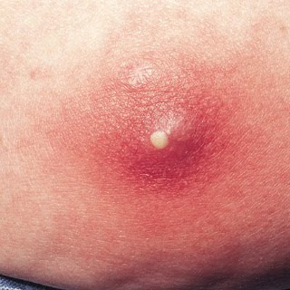 Vaginal itching, burning, and irritation.