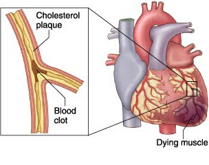 Myocardial Infarction Nursing Care Plan