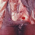 Sifilis pada wanita thumbnail