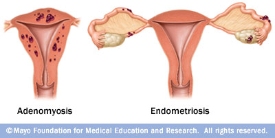 Maksud endometriosis Patofisiologi Endometriosis