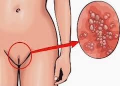 Ciri - Ciri Kutil Kelamin Ciri - Ciri Kutil Kelamin bintik merah vagina