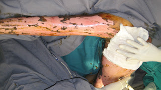 Intralesional steroid injection scar