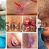 Wasir Internal dan Eksternal, Obatnya Apa Sama thumbnail