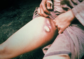 Hình 11: Bệnh dịch hạch, cái chết đen khủng khiếp