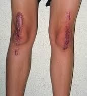 Obat Keloid