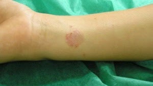 Los medios buenos del hongo de las uñas en los pies las revocaciones
