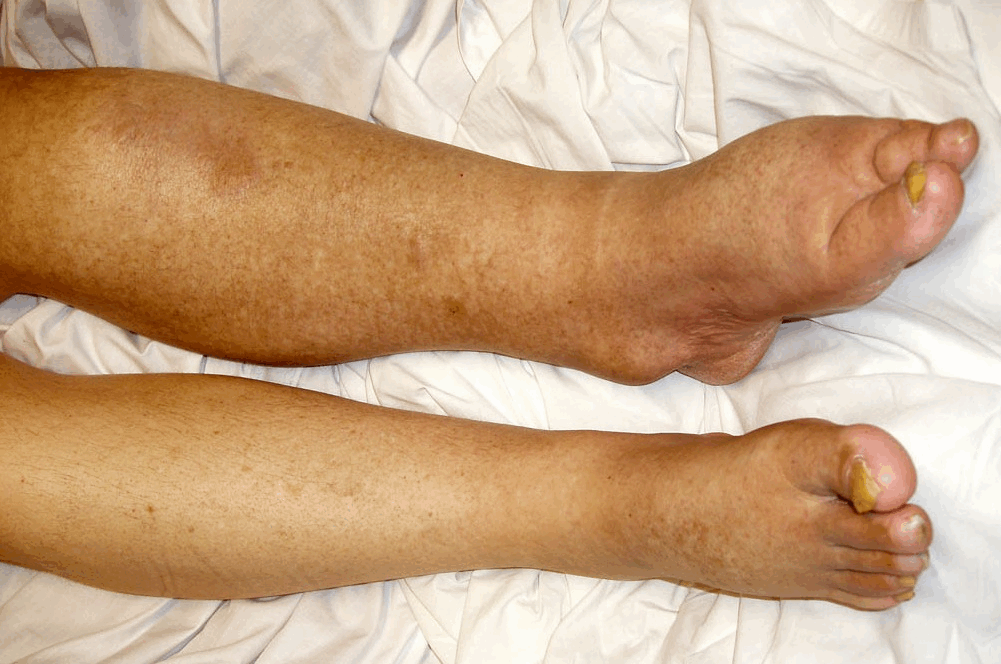 Diuretics for idiopathic edema uvula