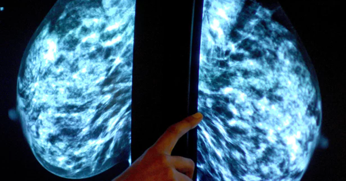 Doctors should avoid saying ‘cancer’ for minor lesions – study