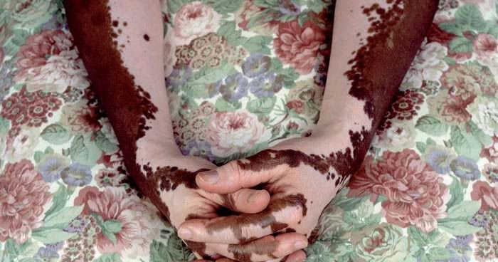 Cara Mengatasi Penyakit Pigmen | OBAT PENYAKIT KEKURANGAN PIGMEN