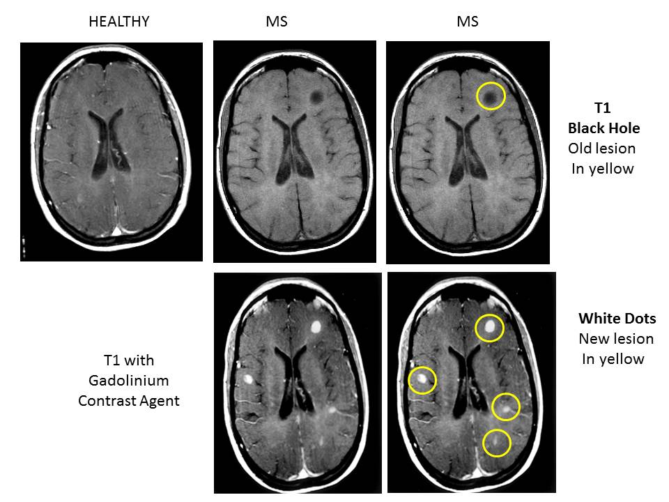 Multiple Sclerosis Research Education. Whats an MRI