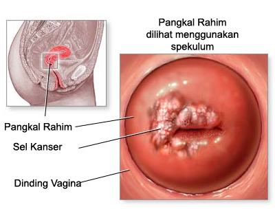 gambar kanser serviks