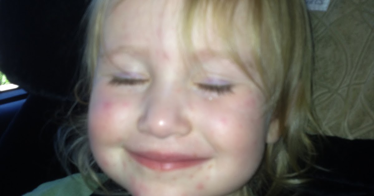 Baby Baker Blog Toddler Fevers and Rash