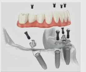 All on Four Dental Implants