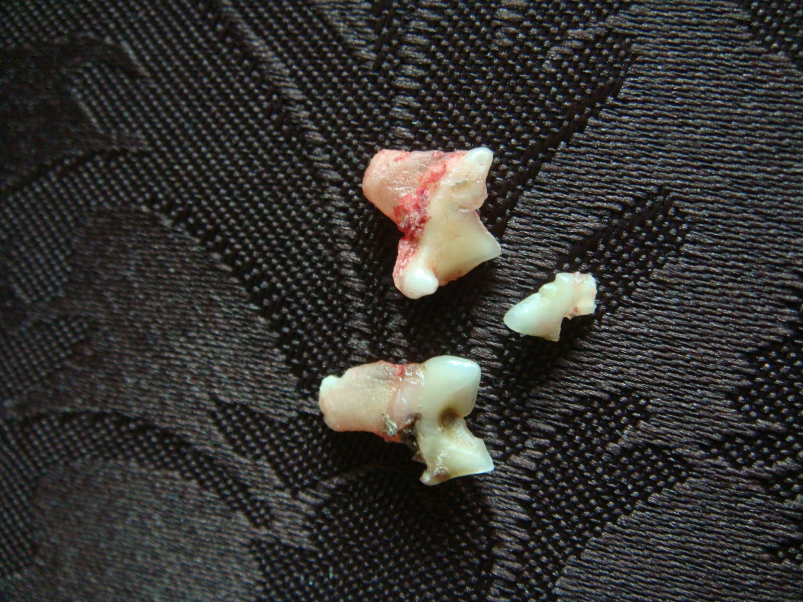 extracted front tooth