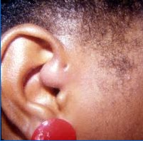 ENT for medical students: ENT PICTURES - EAR