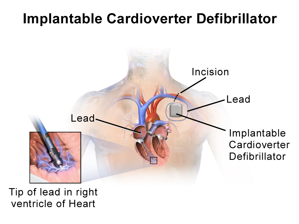 Cardiacare UK Blog Internal Defibrillators Can Reduce Heart Failure By 40