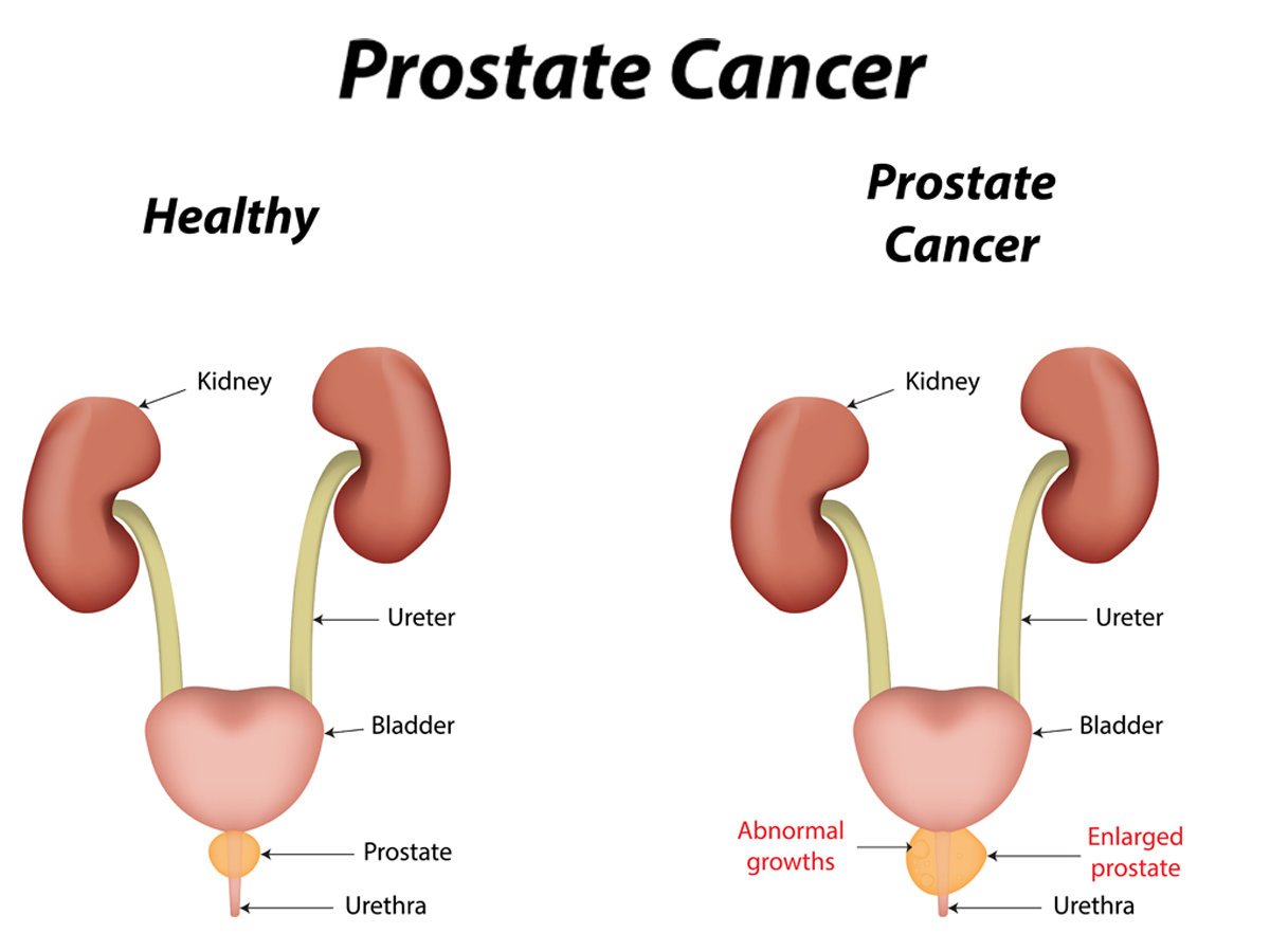 Brazilian prostate