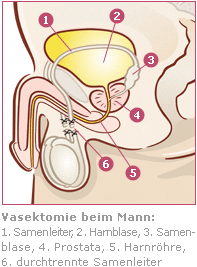 Jahren nach vasektomie schmerzen Vasektomie Köln