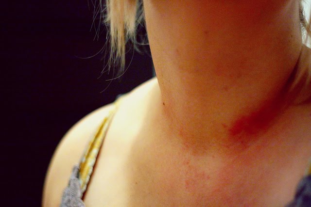 Allergic reaction to fake jewelry