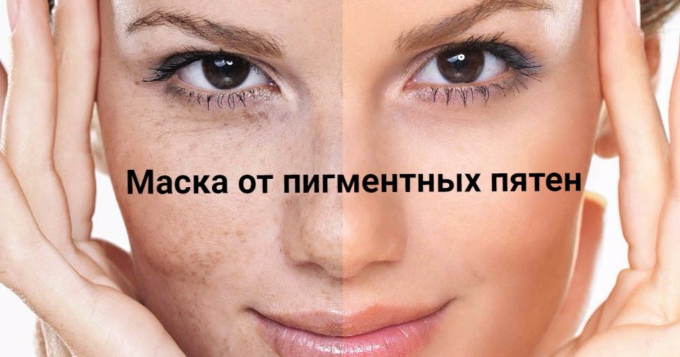 Пигментация как избавится в домашних условиях от
