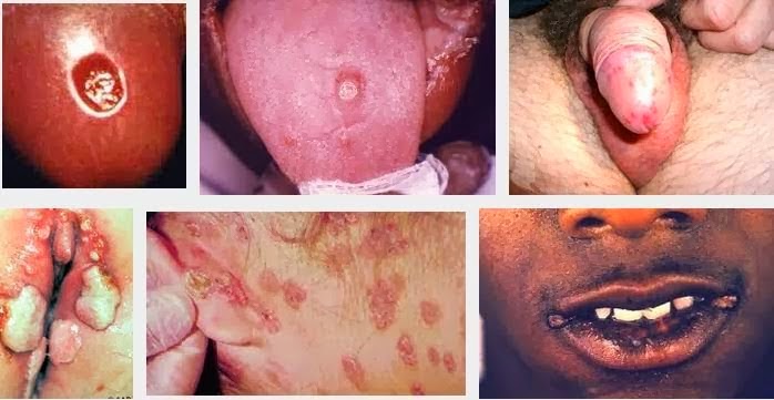 nama obat sipilis di apotik, ciri sakit sipilis, jual obat sipilis di semarang