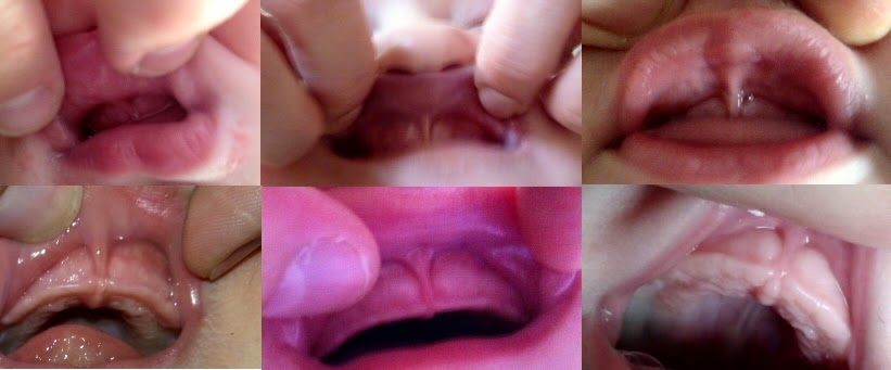 My frenulum ripped i Penile Frenulum,