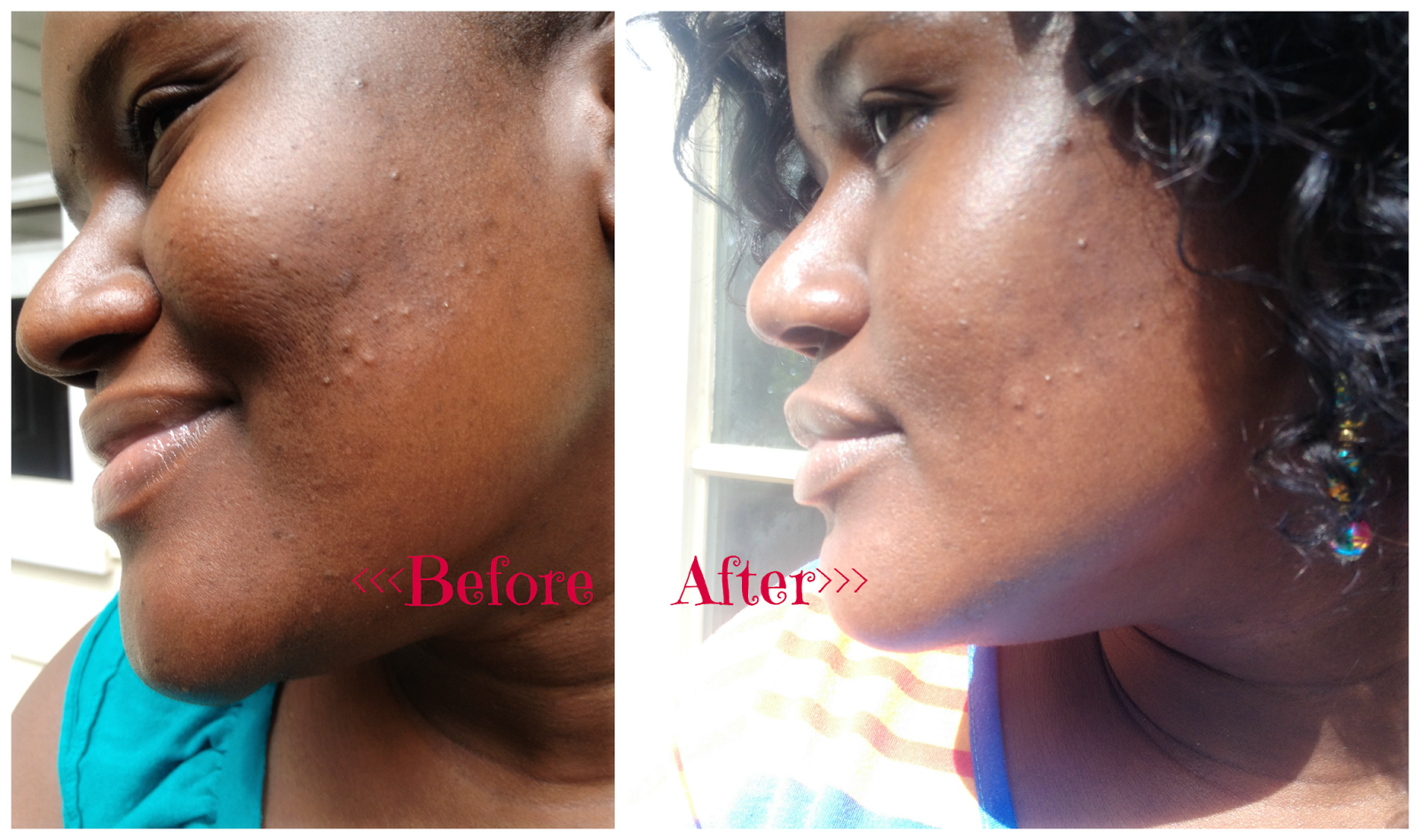 Tea Tree Oil On Face Overnight Tea Tree Oil On Face Overnight