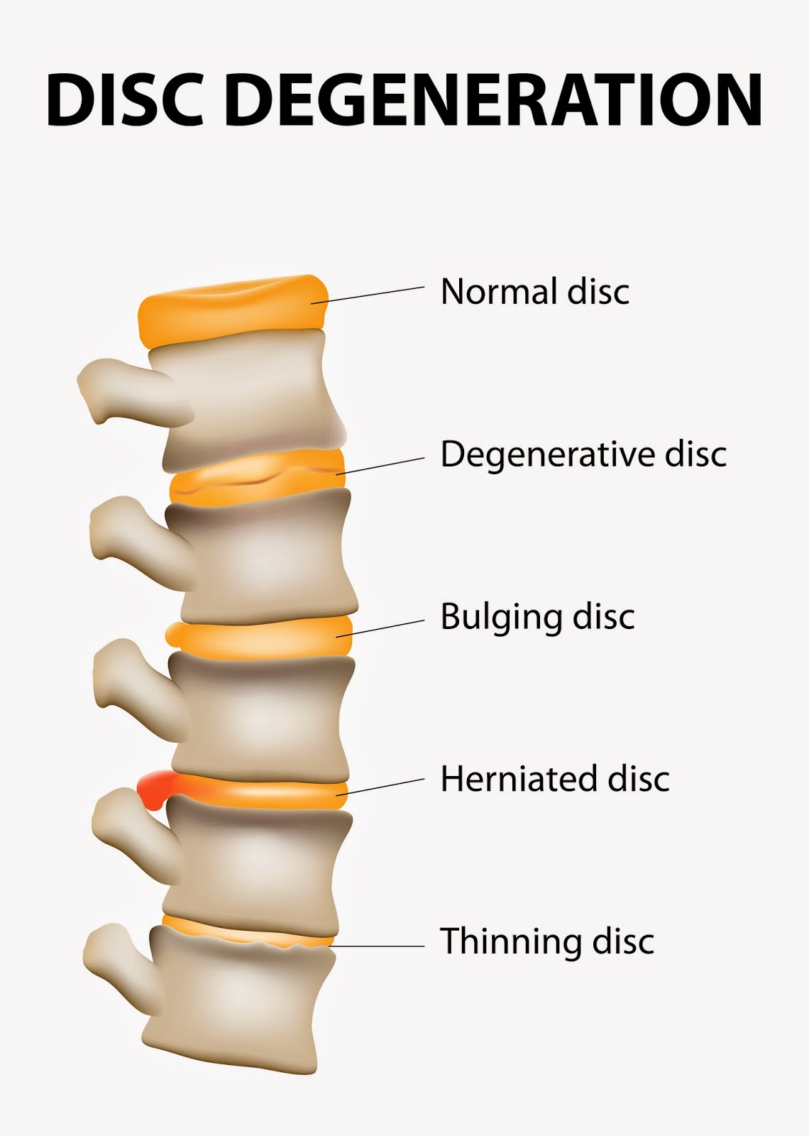 JULY FOCUS - SPINAL DISC PROBLEMS - The Rivermead Osteopaths
