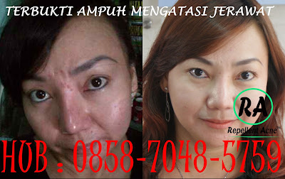 obat jerawat terbaik, obat jerawat ampuh, obat jerawat alami, obat jerawat batu, obat jerawat di apotik