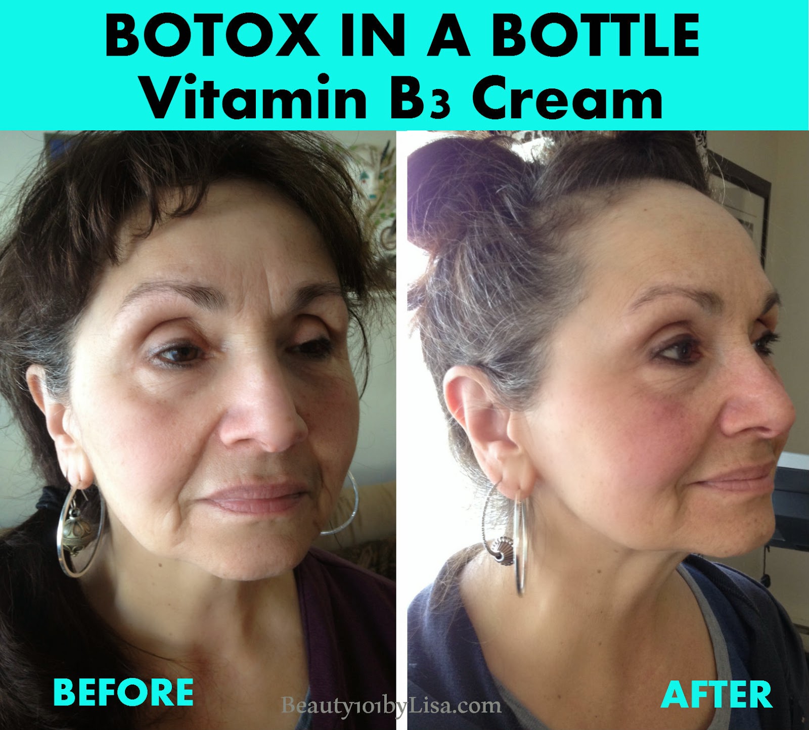BEAUTY101BYLISA BOTOX IN A BOTTLE (Before & After Results)