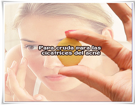 Papa cruda para las cicatrices del acné Belleza facial, acnè,