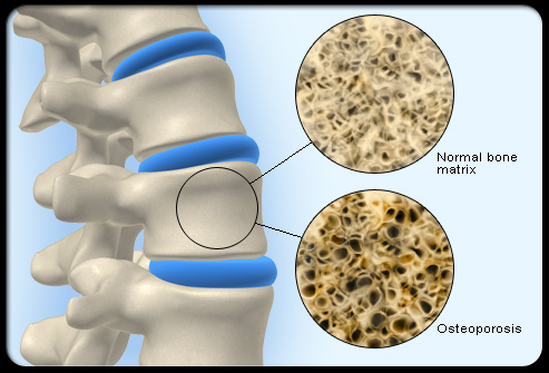 Osteoporosis