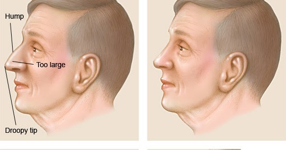 Burun Estetik Fiyatları Ne Kadar?Fiyatı Ne Kadar