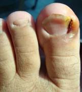 Kemlagi Puskesmasku Ingrowing Toanael